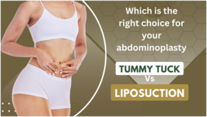 tummy tuck vs liposuction